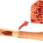 Bone Marrow transplants and LGBTQ+