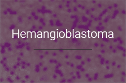 Hemangioblastoma