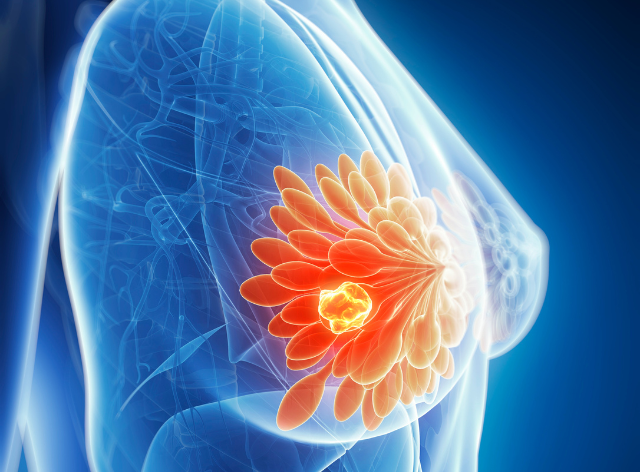 Breast Cancer Treatment Cost in India