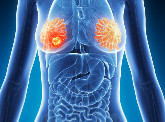 Breast Cancer Treatment in India